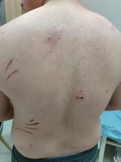 “后背全是！”杭州男子掀起衣服吓坏，有医院一天接诊120多例