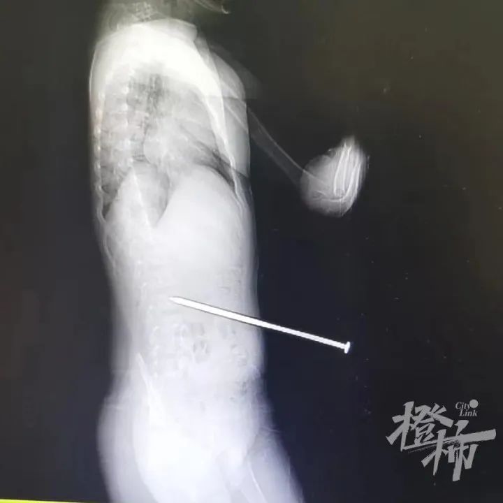 太险了！6岁男孩瞬间被长钉插入腰部！多地明确禁止！
