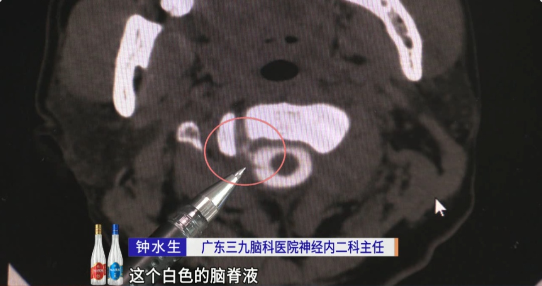 男子脑子“漏水”疼痛难忍，竟是因为一次急刹车？