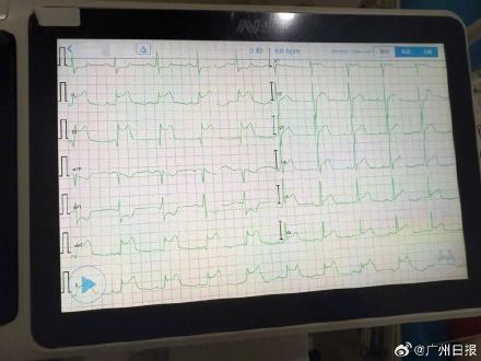 一年轻人胸痛查出心肌梗死，医生：春夏之交更要警惕这种病