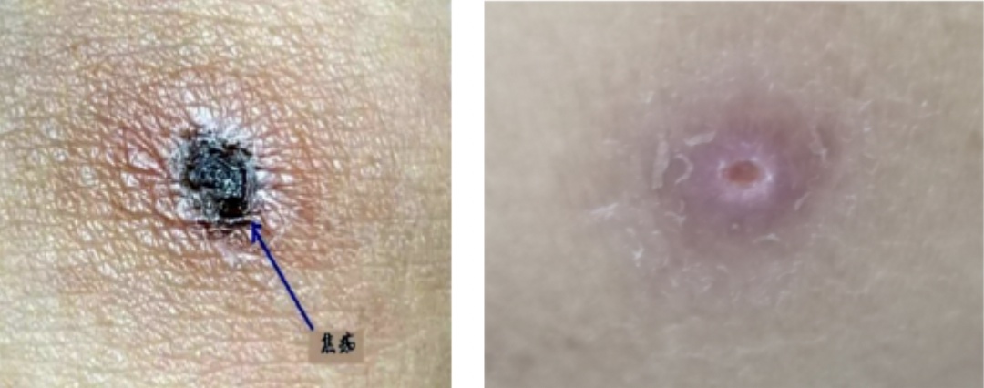 一次踏青，女子差点送命！身上一颗黑痂暴露病因！医生：五一出游高度警惕