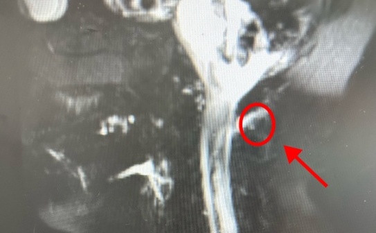 一次急刹车致男子脑子“漏水”?这些动作要当心! 一次急刹车致男子脑子“漏水”?这些动作要当心!