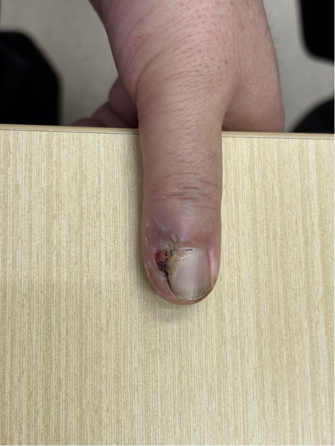 指甲长出怪东西，拔甲数次无效！医生切开后倒吸凉气：竟是癌症