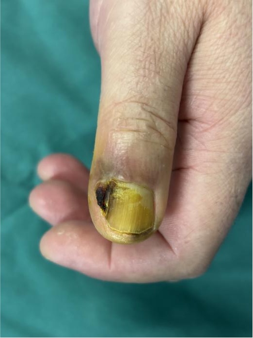 指甲长出怪东西，拔甲数次无效！医生切开后倒吸凉气：竟是癌症