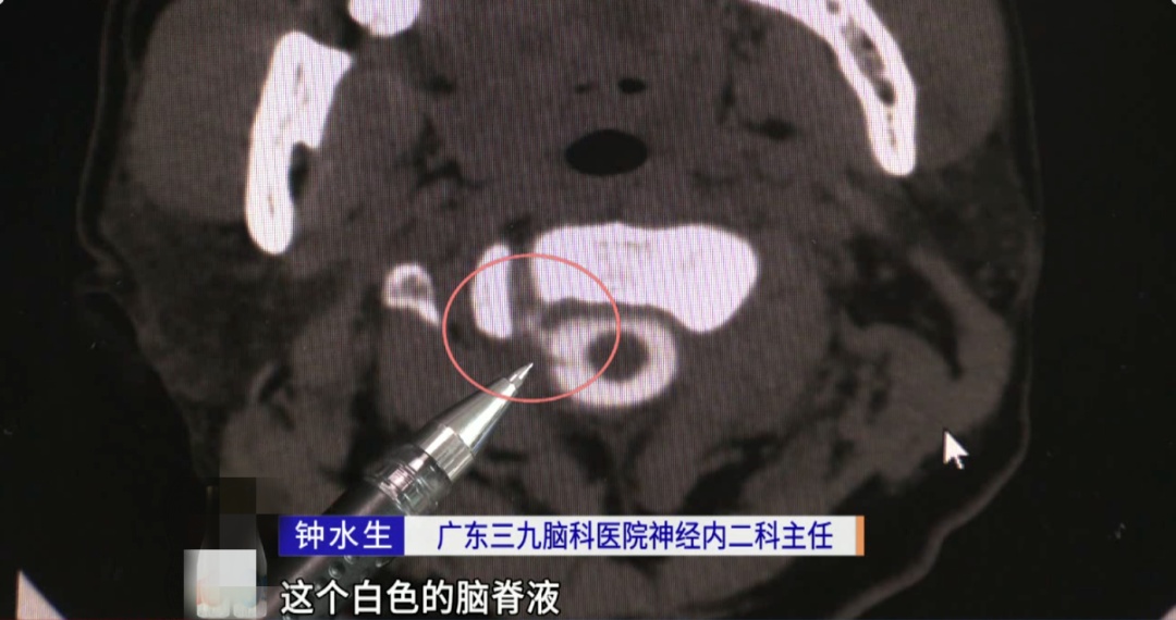 可怕！32岁男子脑子“漏水”，竟与这个动作有关