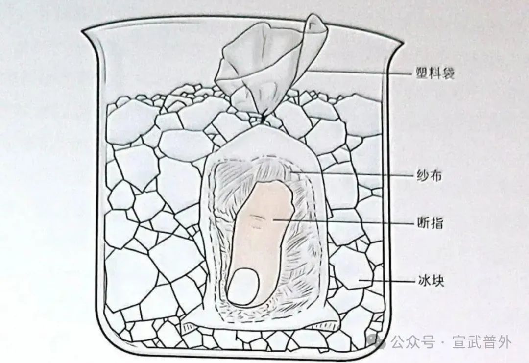 手指离断,我们能做些什么呢? 手指离断,我们能做些什么呢?