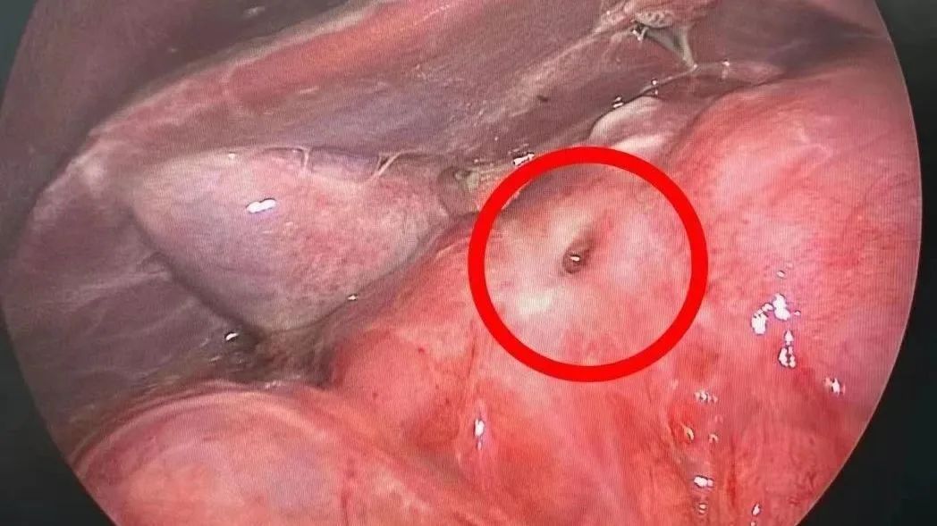 当心可乐变成“穿孔水”!出现这些症状要小心 当心可乐变成“穿孔水”!出现这些症状要小心