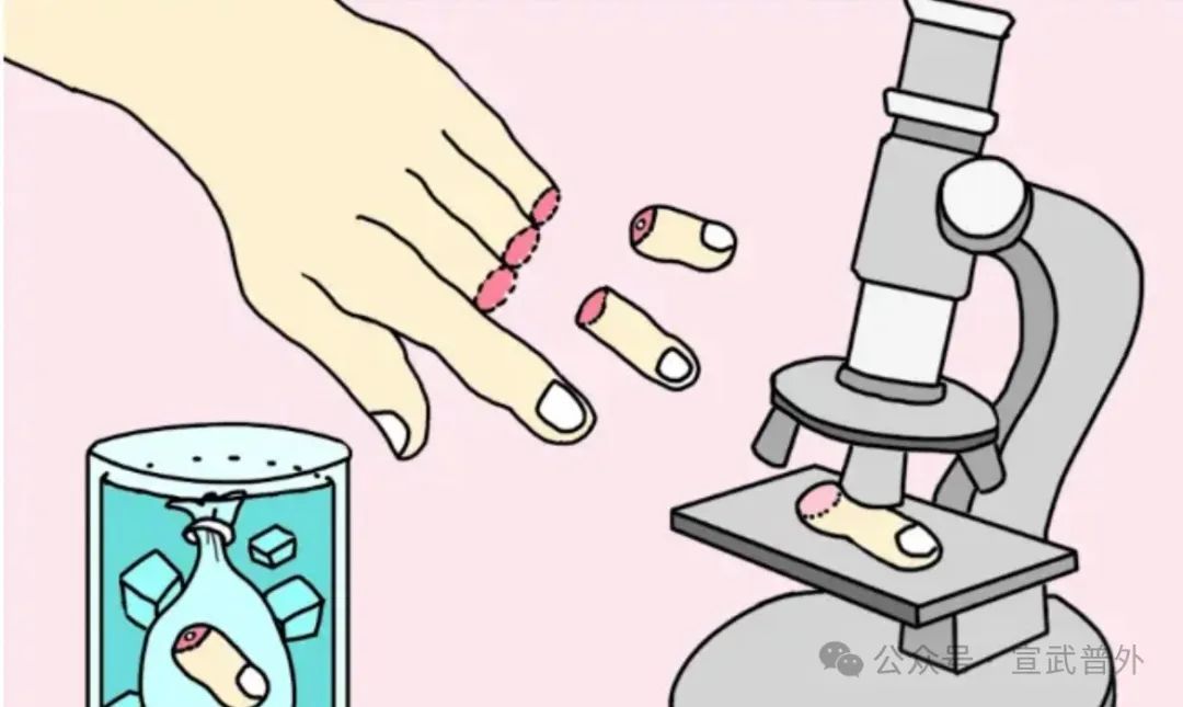 手指离断,我们能做些什么呢? 手指离断,我们能做些什么呢?