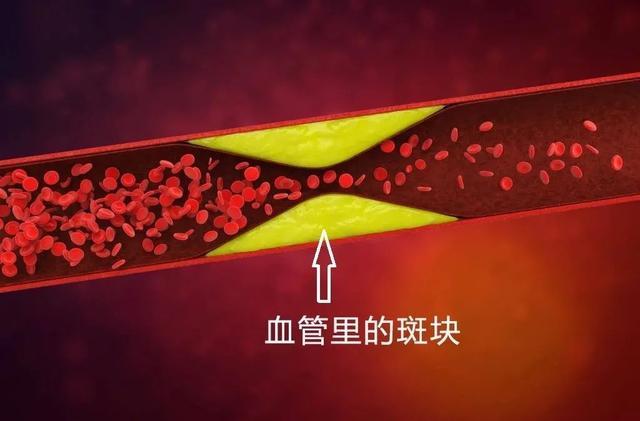 “斑块”在堵死血管之前，用3个信号提醒你