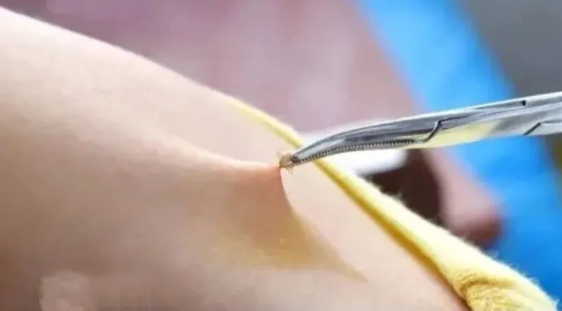 病死率高达20%!“五一”出游谨防蜱虫叮咬,预防指南来了 病死率高达20%!“五一”出游谨防蜱虫叮咬,预防指南来了