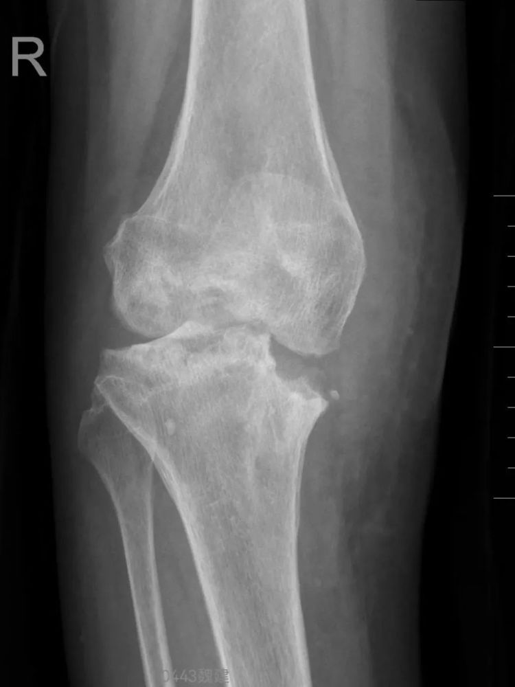 膝盖肿痛，骨头差点被“啃空”！别忽视这些早期症状