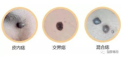 男子指甲长出怪东西,一查惊了:竟是癌症…… 男子指甲长出怪东西,一查惊了:竟是癌症……