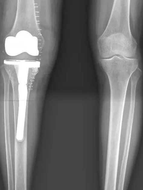 膝盖肿痛，骨头差点被“啃空”！别忽视这些早期症状