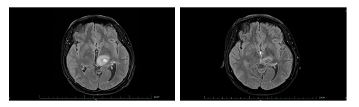 女子因忽视手脚发麻，4个月后确诊脑癌