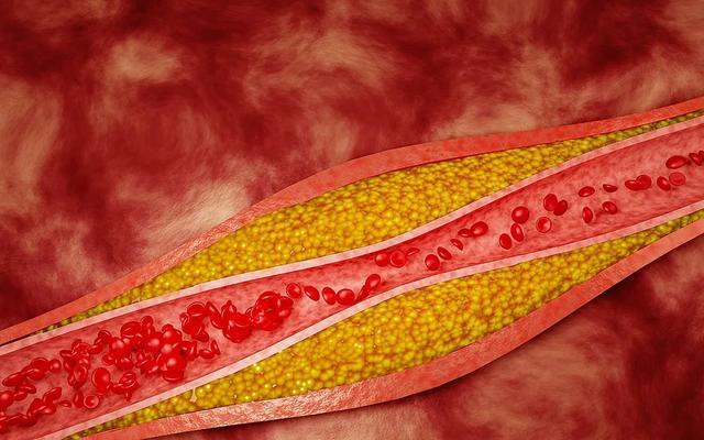 “斑块”在堵死血管之前，用3个信号提醒你