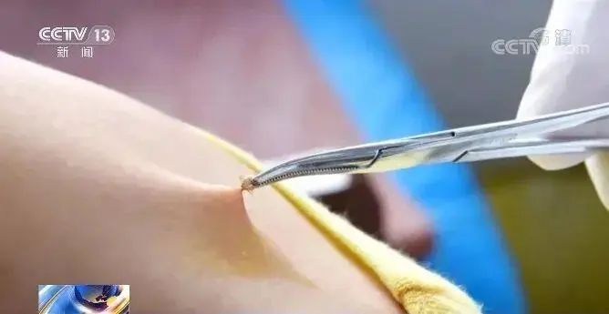 蜱虫活跃期,千万不要硬拔或拍死!疾控提醒 蜱虫活跃期,千万不要硬拔或拍死!疾控提醒