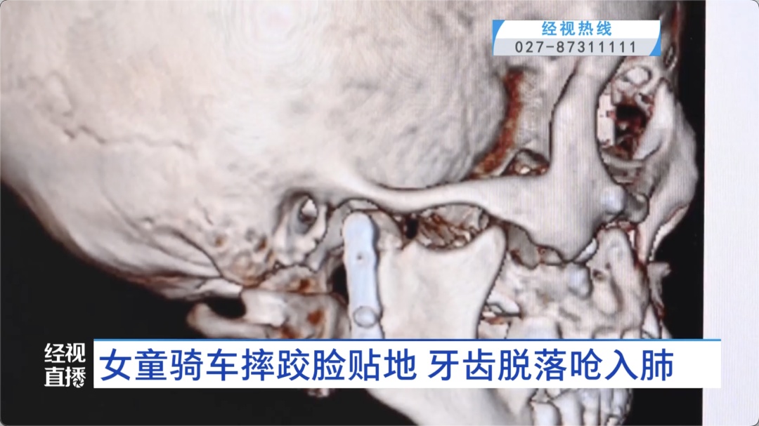 8岁女童骑车摔跤致面部重创,牙齿脱落进入支气管!医生紧急提醒 8岁女童骑车摔跤致面部重创,牙齿脱落进入支气管!医生紧急提醒
