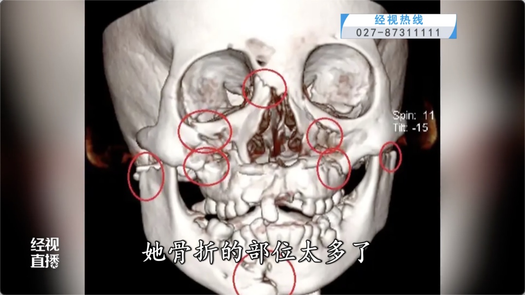 8岁女童骑车摔跤致面部重创,牙齿脱落进入支气管!医生紧急提醒 8岁女童骑车摔跤致面部重创,牙齿脱落进入支气管!医生紧急提醒