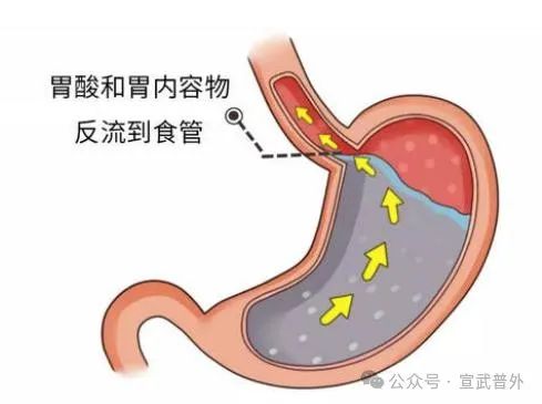 深夜的“酸爽”突袭——胃食管反流 深夜的“酸爽”突袭——胃食管反流