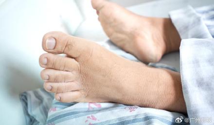 男子中年变丑竟因长了脑肿瘤