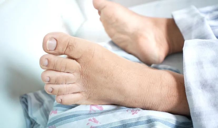 鼻变大、唇肿大!男子越变越“丑”,祸因竟是脑肿瘤 鼻变大、唇肿大!男子越变越“丑”,祸因竟是脑肿瘤