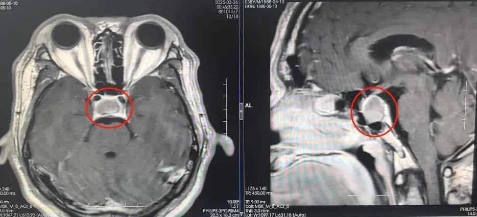 鼻变大、唇肿大!男子越变越“丑”,祸因竟是脑肿瘤 鼻变大、唇肿大!男子越变越“丑”,祸因竟是脑肿瘤