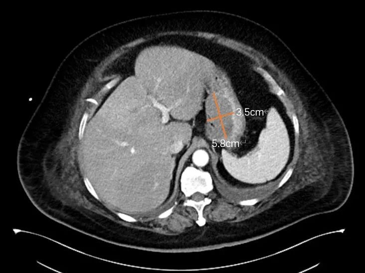 女子吓懵！平时没感觉，一查肿瘤竟比鸡蛋大……紧急提醒：这类人群特别注意