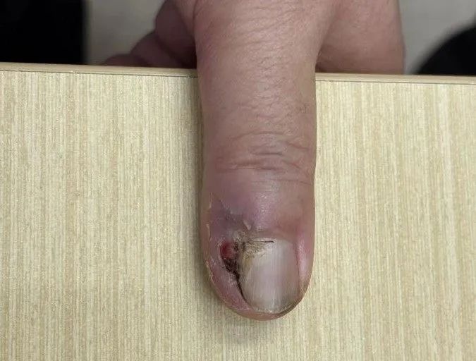 指甲长出怪东西，拔甲数次无效！医生切开后惊了