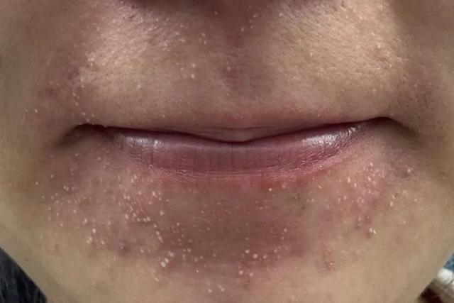 近期高发！这种小红疙瘩奇痒难耐，很多人却错把它当痘痘治，白白遭罪
