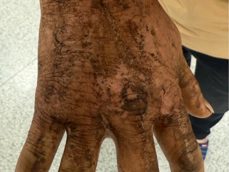 被咬一口肿到发胀！多地已出现，看到赶紧远离！