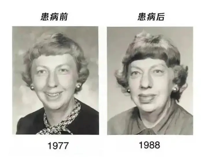 太蹊跷！上海阿姨一年间容貌大变，鼻子嘴巴都不对劲...医生警觉→