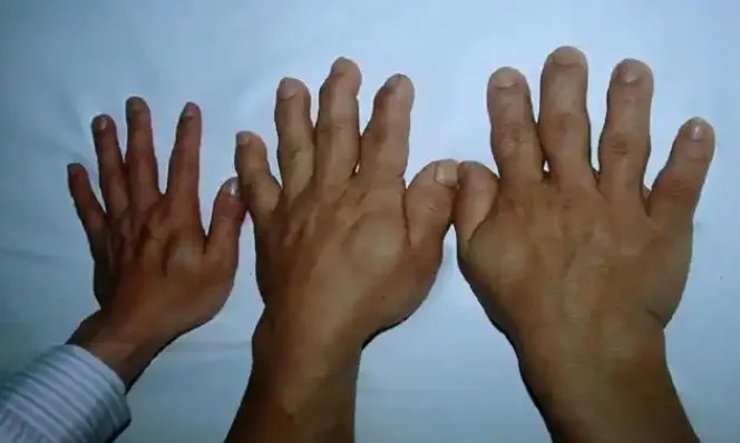 太蹊跷！上海阿姨一年间容貌大变，鼻子嘴巴都不对劲...医生警觉→