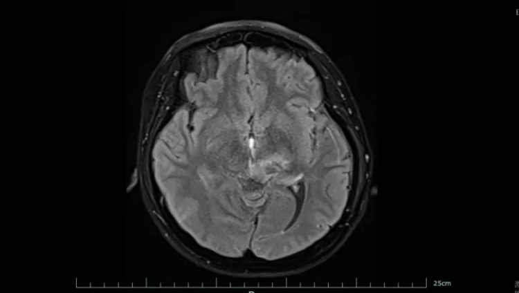 警惕！30岁女子手脚发麻没在意，4个月后确诊脑癌！医生痛心：这些症状早就提醒了……