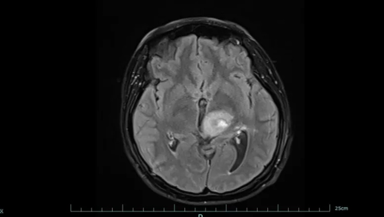 警惕！30岁女子手脚发麻没在意，4个月后确诊脑癌！医生痛心：这些症状早就提醒了……