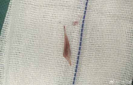 女子误吞鱼刺扎破心脏险丧命 女子误吞鱼刺扎破心脏险丧命