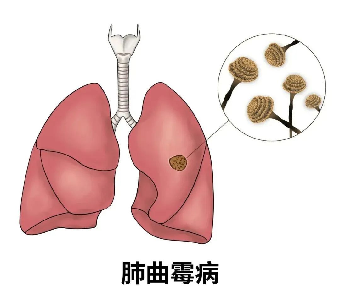 女子家里中招致肺部“发霉”，快检查，你家可能也有！