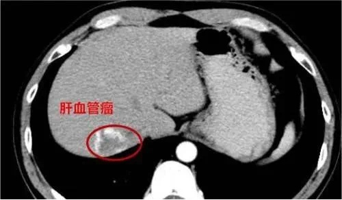 女生晒电筒照手图被网友发现不对劲!检查后确诊血管瘤立马住院手术,医生提醒 女生晒电筒照手图被网友发现不对劲!检查后确诊血管瘤立马住院手术,医生提醒