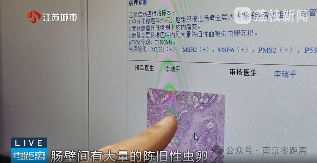 结肠出现巨大肿块,肠壁有虫卵!61岁男子头晕乏力误以为贫血发作! 结肠出现巨大肿块,肠壁有虫卵!61岁男子头晕乏力误以为贫血发作!