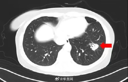 女子整理衣柜致肺部长满霉斑 官方提醒：清洁时佩戴好口罩！！