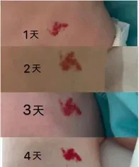 女生晒照被网友提醒有“瘤”？真的救命了！医生回应……