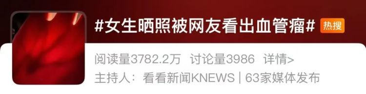 女生晒照被网友提醒有“瘤”？真的救命了！医生回应……