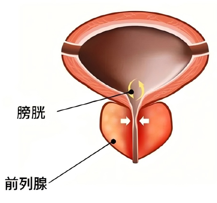 这种癌症,偏爱 “男同胞”!速查你是不是 “高危人群”→ 这种癌症,偏爱 “男同胞”!速查你是不是 “高危人群”→