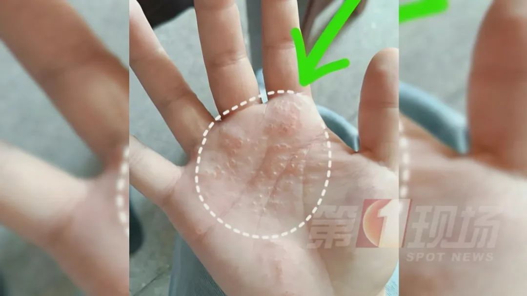 痒痒痒痒痒痒痒！但别抓...广东夏季易高发
