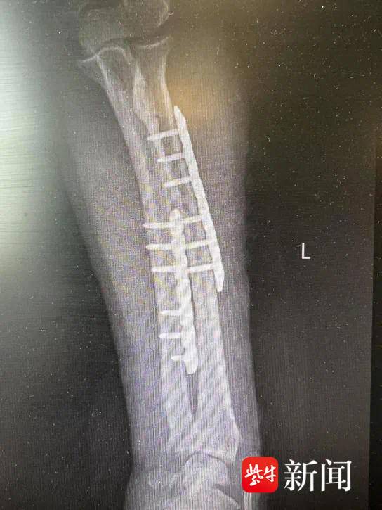 她用手语比出“谢谢”！六旬聋哑阿姨被割草机锯断手臂，医生紧急施救后转危为安