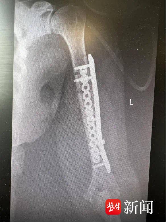 她用手语比出“谢谢”！六旬聋哑阿姨被割草机锯断手臂，医生紧急施救后转危为安