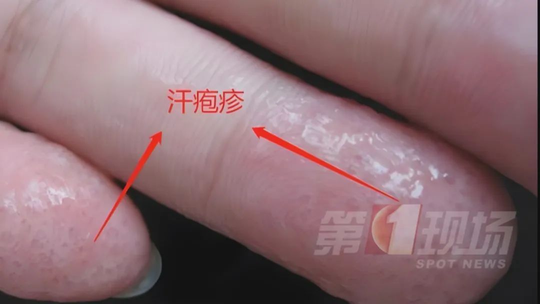 痒痒痒痒痒痒痒！但别抓...广东夏季易高发