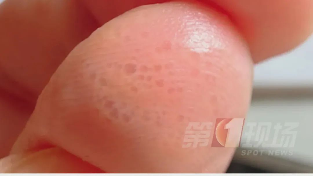 痒痒痒痒痒痒痒！但别抓...广东夏季易高发