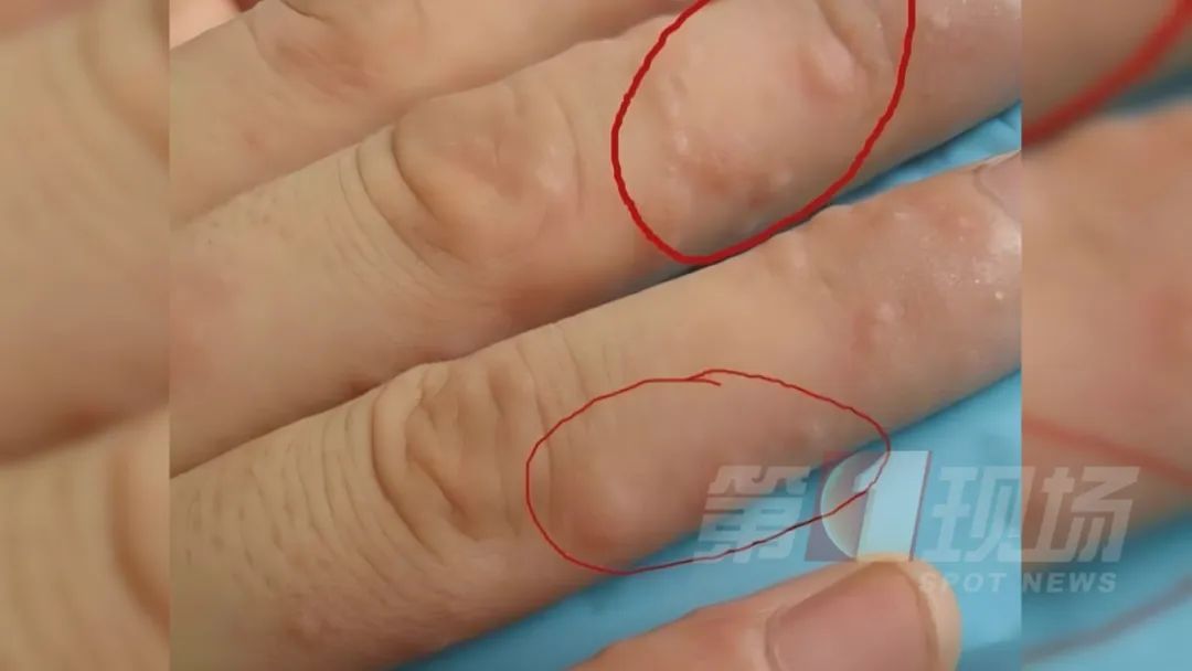 痒痒痒痒痒痒痒！但别抓...广东夏季易高发