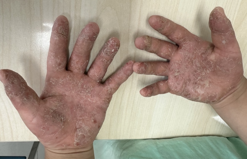 花椒煮水+醋+蒜！老人上偏方给孙子祛湿，一双小手红肿溃烂……