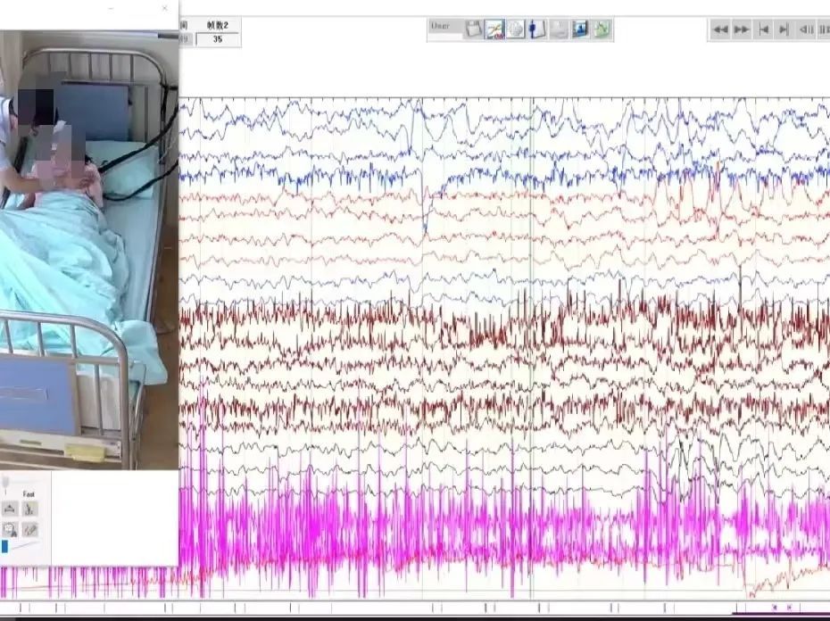 半夜猛然坐起!快速蹬腿、面露惊恐……6岁女孩反复发作,去了医院才知道竟是这问题 半夜猛然坐起!快速蹬腿、面露惊恐……6岁女孩反复发作,去了医院才知道竟是这问题